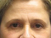Brow Lift