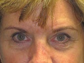 Brow Lift