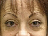 Brow Lift