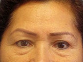 Brow Lift