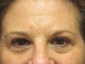 Brow Lift
