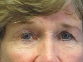 Brow Lift