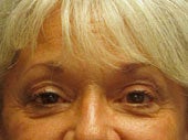 Brow Lift
