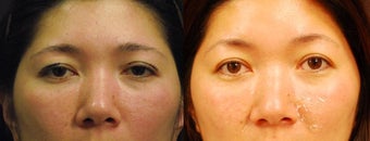 Brow lift
