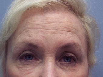 Brow lift