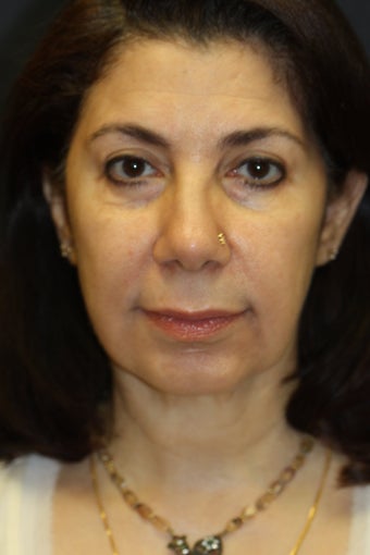 Chin Augmentation with upper/lower blepharoplasty, facelift, radiesse, and buccal fat removal