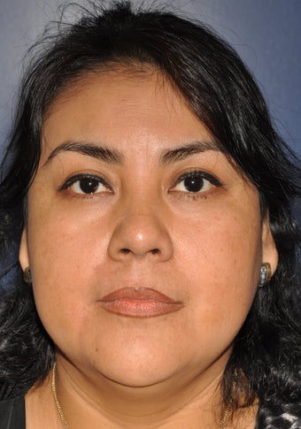 Buccal Fat Removal
