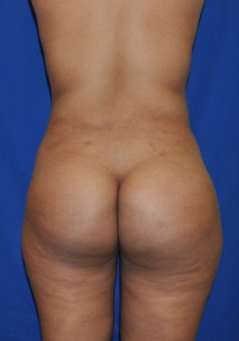 Buttock Augmentation using Fat Transfer