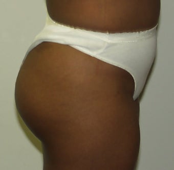 Butt Augmentation