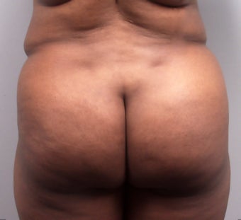 Butt Augmentation