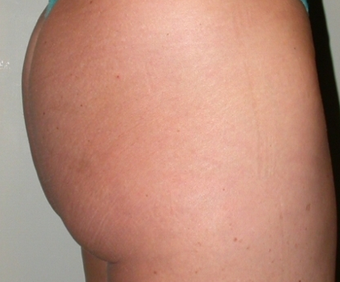 Fat Transfer