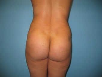 Buttock augmentation (Brazilian buttock lift)