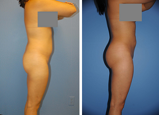 Buttocks Enhancement