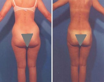 Buttocks Enhancement