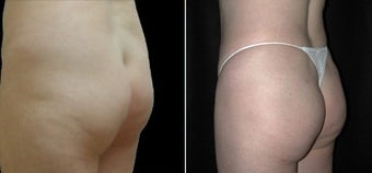 Buttock Augmentation 