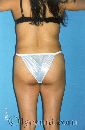 Butock Augmentation