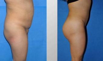 Butt Augmentation