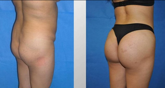 Butt Augmentation