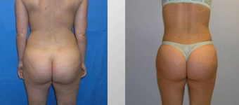 Butt Augmentation
