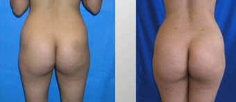 Butt Augmentation