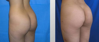 Butt Augmentation