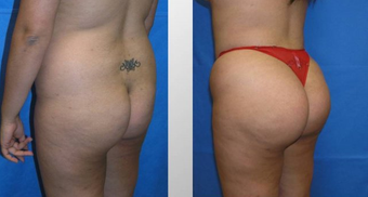 Butt Augmentation