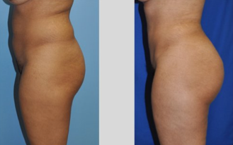 Buttock Augmentation