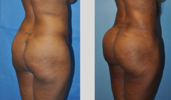 Buttock Augmentation