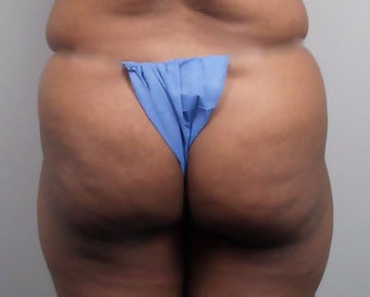 Butt Augmentation