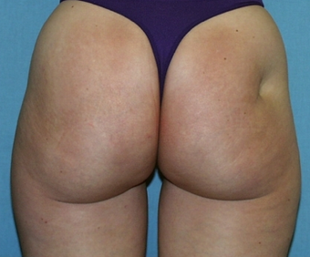 Fat Transfer