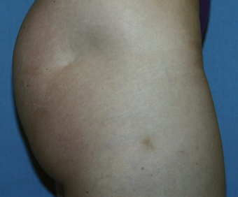 Fat Transfer