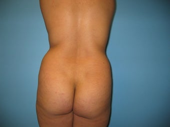 Buttock augmentation (Brazilian buttock lift)
