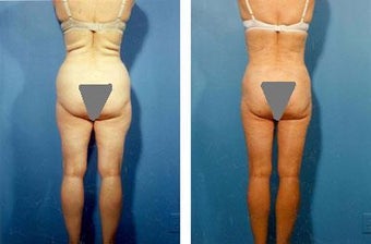 Buttocks Enhancement