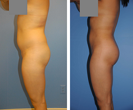 Buttocks Enhancement