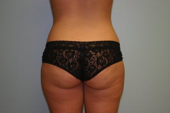 Buttock Augmentation (Fat Transfer)
