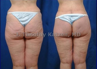 Before and after photo silicone buttock implant and lift after RNY gastric bypass after massive weight loss after 360 bodylift