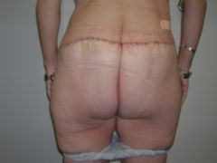 Gluteal Lift