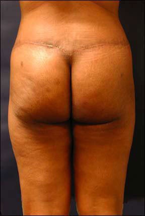 Butt Lift