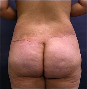 Butt Lift