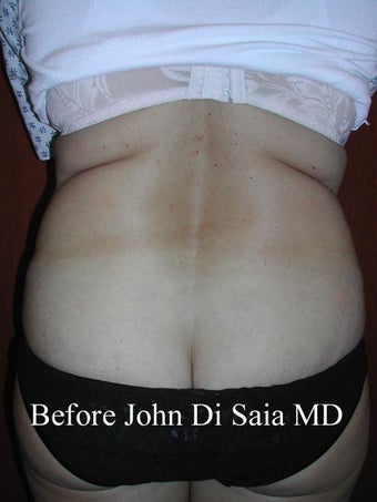 Butt Lift in a prior Tummy Tuck Patient 