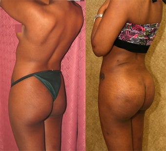 butt augmentation
