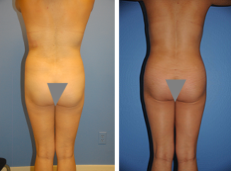Buttocks Enhancement