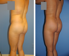 Buttocks Enhancement