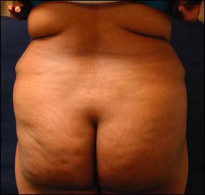 Butt Lift