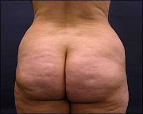 Butt Lift
