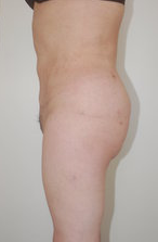 Butt Augmentation