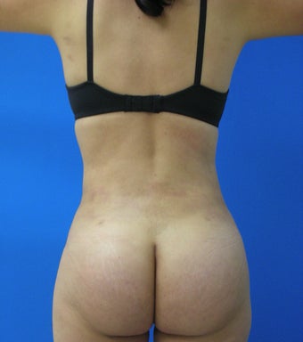 Brazilian Butt Lift