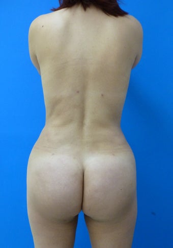 Brazilian Butt Lift