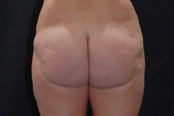 Buttock Augmentation through Fat Transfer