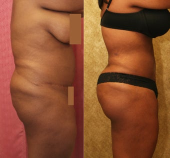Brazilian buttock augmentation with fat grafting to the buttocks with liposuction in Los Angeles